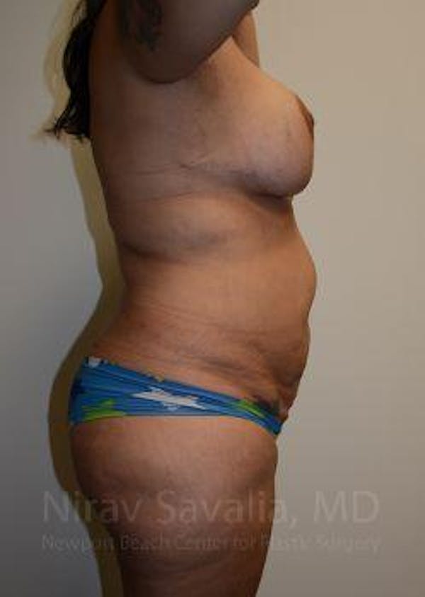 Breast Lift without Implants Before & After Gallery - Patient 1655657 - Before