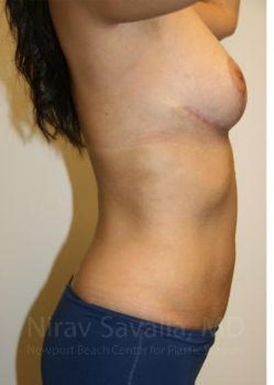 Breast Reduction Before & After Gallery - Patient 1655658 - After