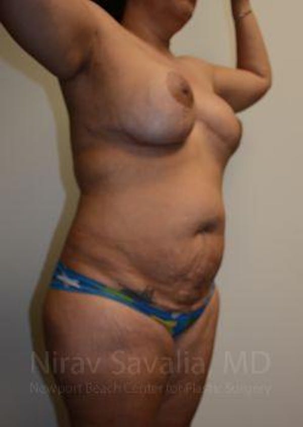 Male Breast Reduction Before & After Gallery - Patient 1655660 - Before