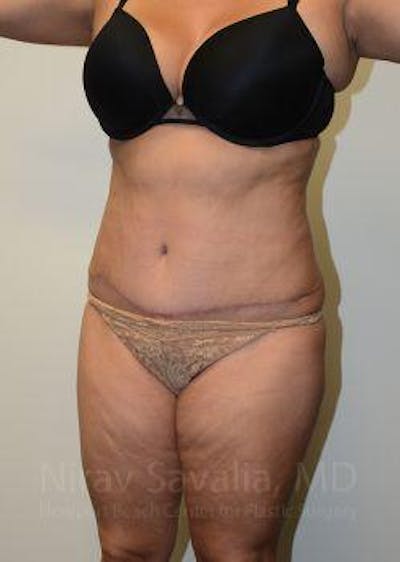 Fat Grafting to Face Before & After Gallery - Patient 1655659 - After