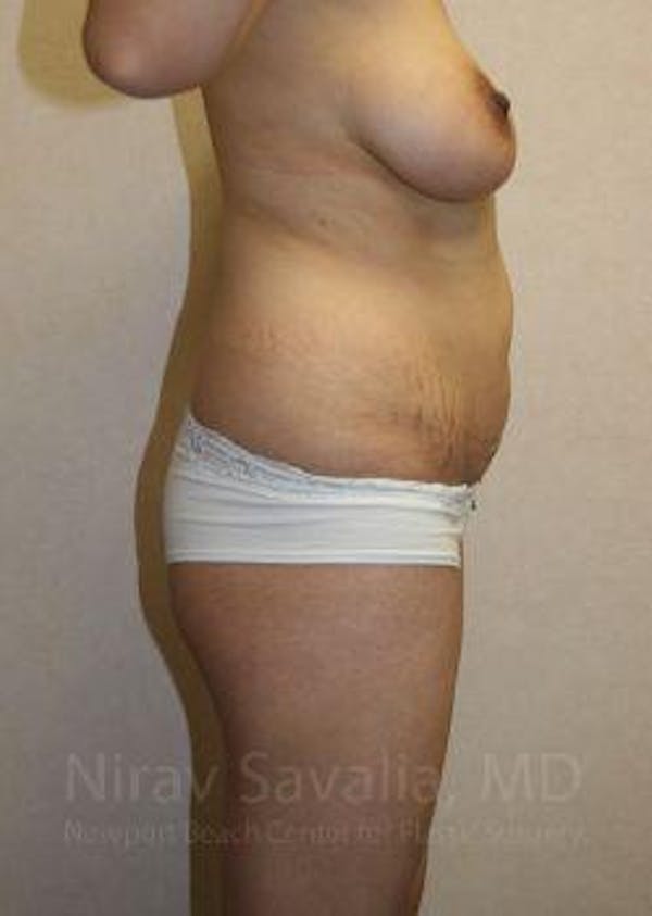 Breast Lift without Implants Before & After Gallery - Patient 1655661 - Before