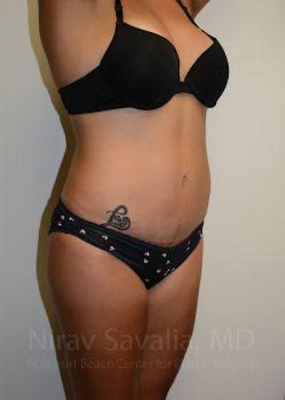 Breast Reduction Before & After Gallery - Patient 1655662 - After