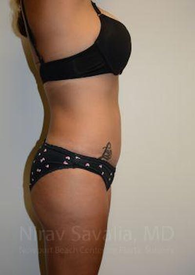 Breast Reduction Before & After Gallery - Patient 1655662 - After