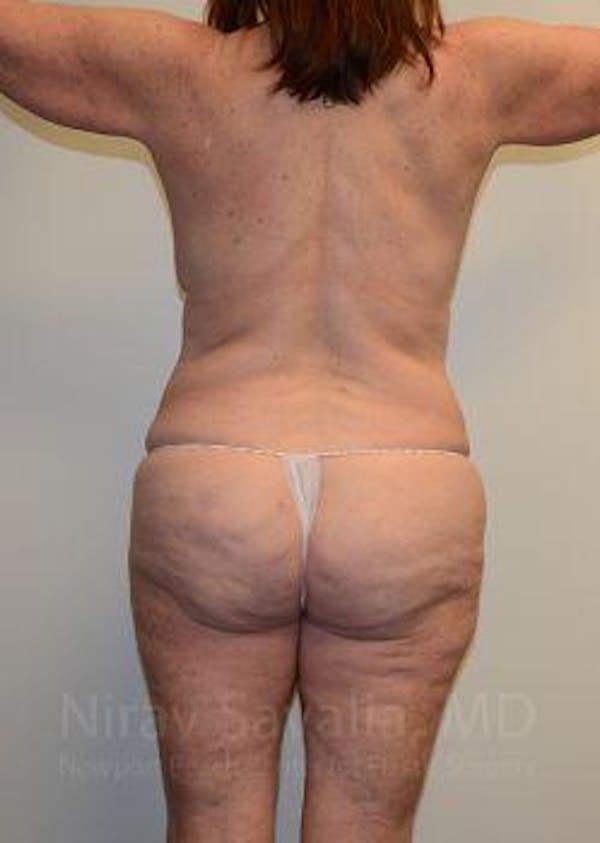 Fat Grafting to Face Before & After Gallery - Patient 1655663 - Before