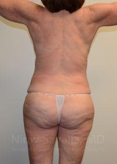 Fat Grafting to Face Before & After Gallery - Patient 1655663 - After