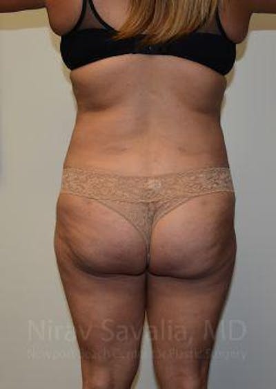 Breast Reduction Before & After Gallery - Patient 1655664 - After