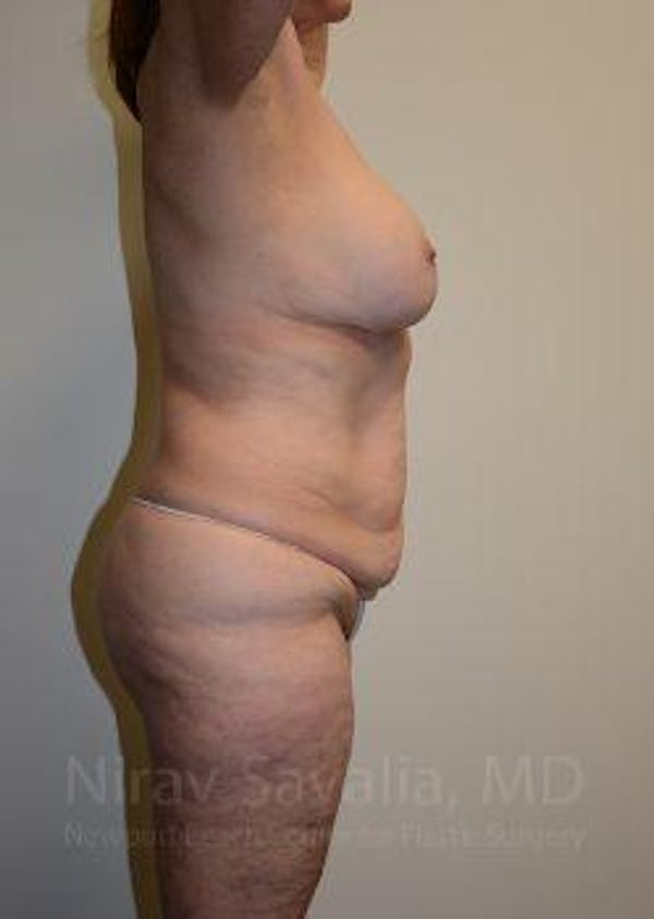 Fat Grafting to Face Before & After Gallery - Patient 1655663 - Before