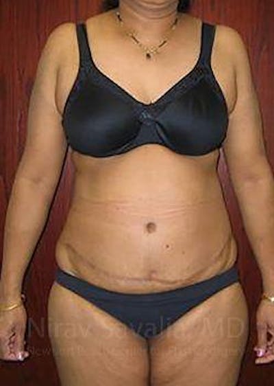 Abdominoplasty Tummy Tuck Before & After Gallery - Patient 1655665 - After