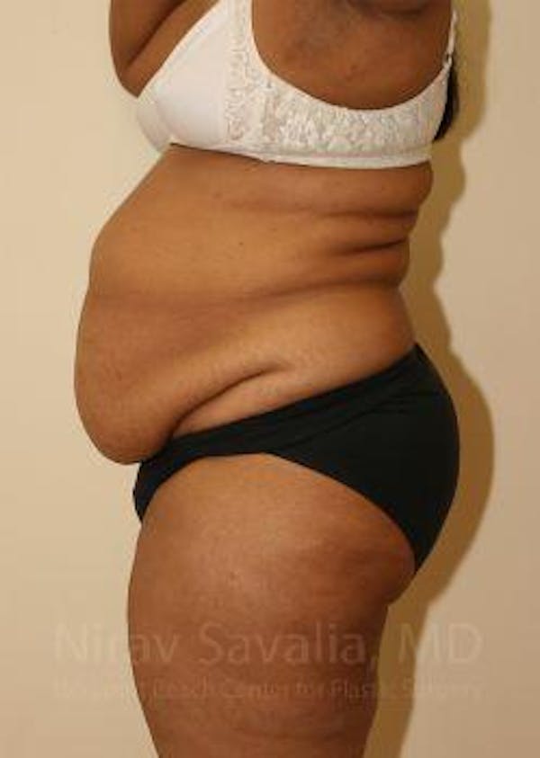 Abdominoplasty Tummy Tuck Before & After Gallery - Patient 1655665 - Before