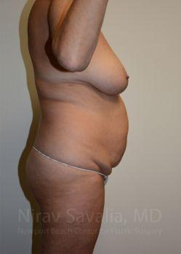 Liposuction Before & After Gallery - Patient 1655668 - Before