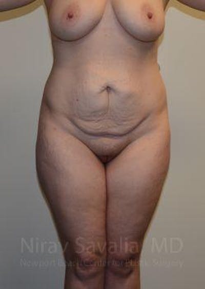 Fat Grafting to Face Before & After Gallery - Patient 1655670 - Before