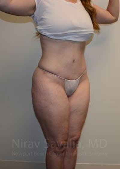 Fat Grafting to Face Before & After Gallery - Patient 1655670 - After