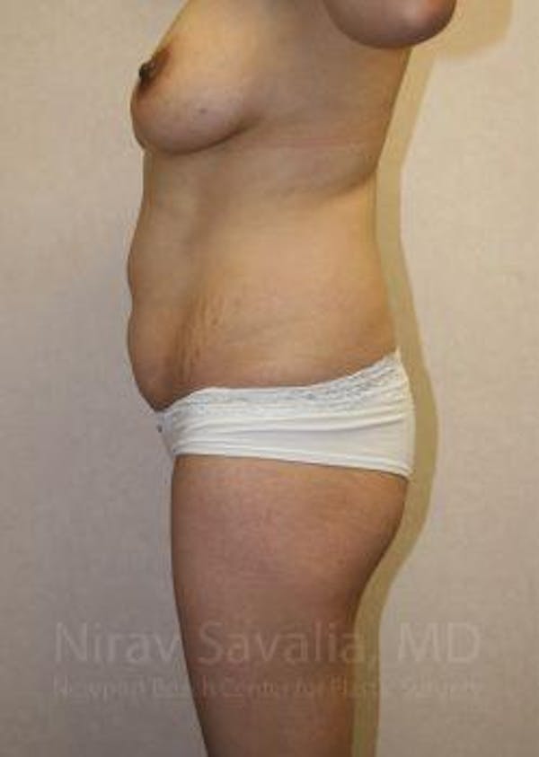 Male Breast Reduction Before & After Gallery - Patient 1655671 - Before