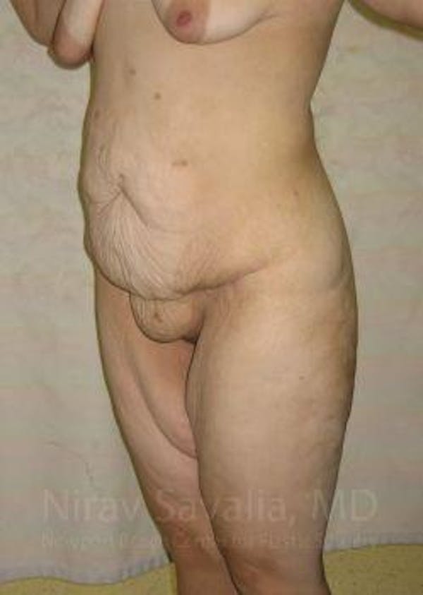 Liposuction Before & After Gallery - Patient 1655677 - Before