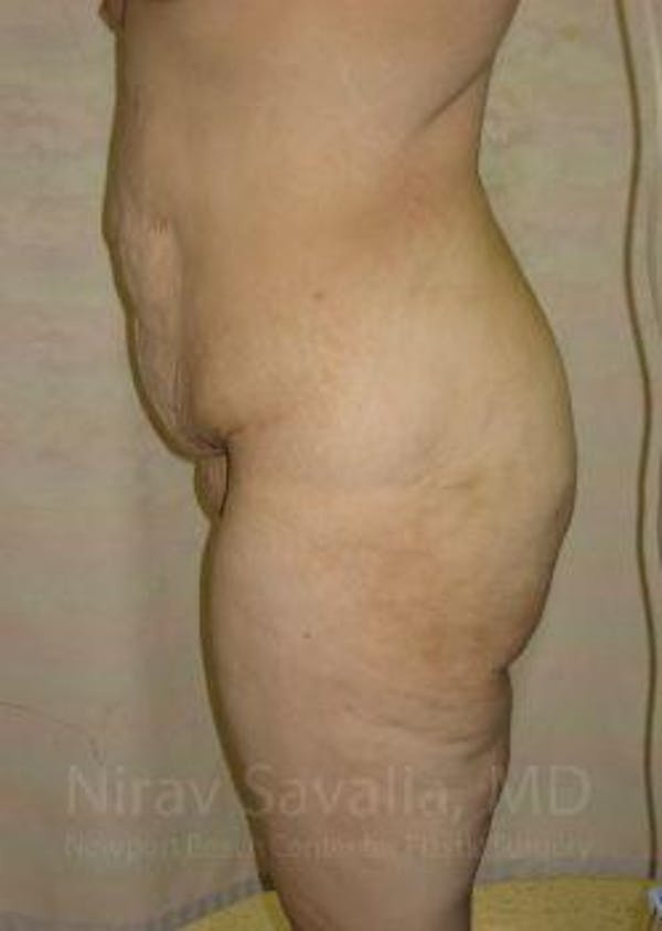 Liposuction Before & After Gallery - Patient 1655677 - Before