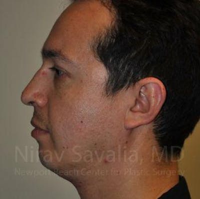 Fat Grafting to Face Before & After Gallery - Patient 1655678 - Before