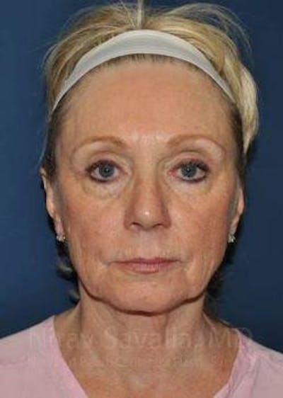 Eyelid Surgery Before & After Gallery - Patient 1655681 - Before