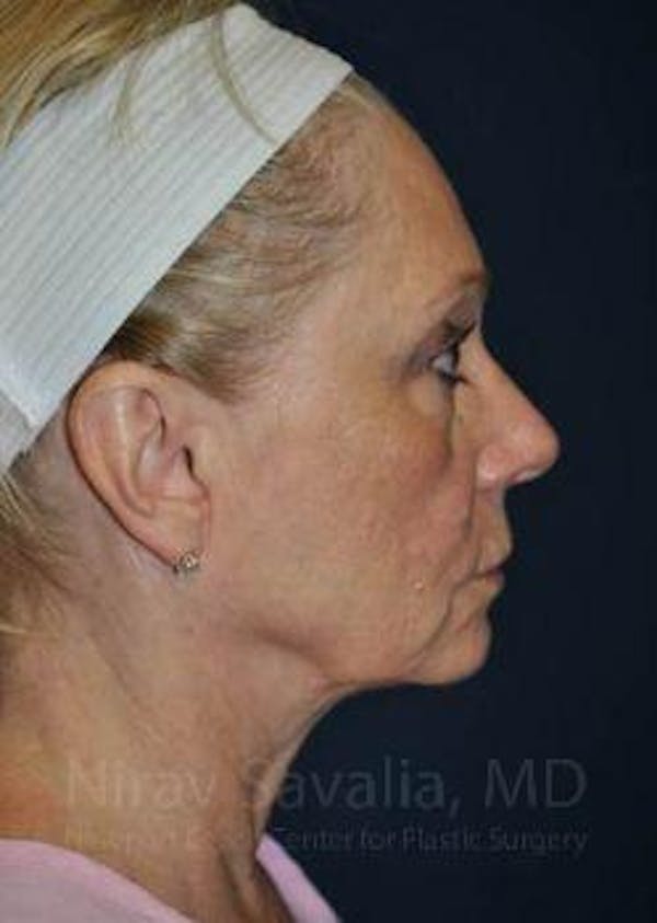 Eyelid Surgery Before & After Gallery - Patient 1655681 - Before