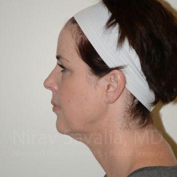 Fat Grafting to Face Before & After Gallery - Patient 1655683 - Before