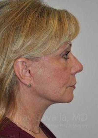 Eyelid Surgery Before & After Gallery - Patient 1655681 - After