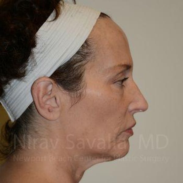 Fat Grafting to Face Before & After Gallery - Patient 1655690 - Before