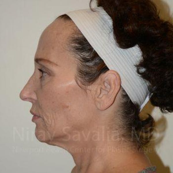 Fat Grafting to Face Before & After Gallery - Patient 1655690 - Before