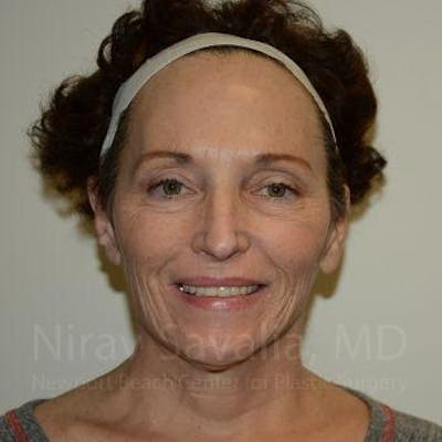 Mastectomy Reconstruction Revision Before & After Gallery - Patient 1655693 - Before