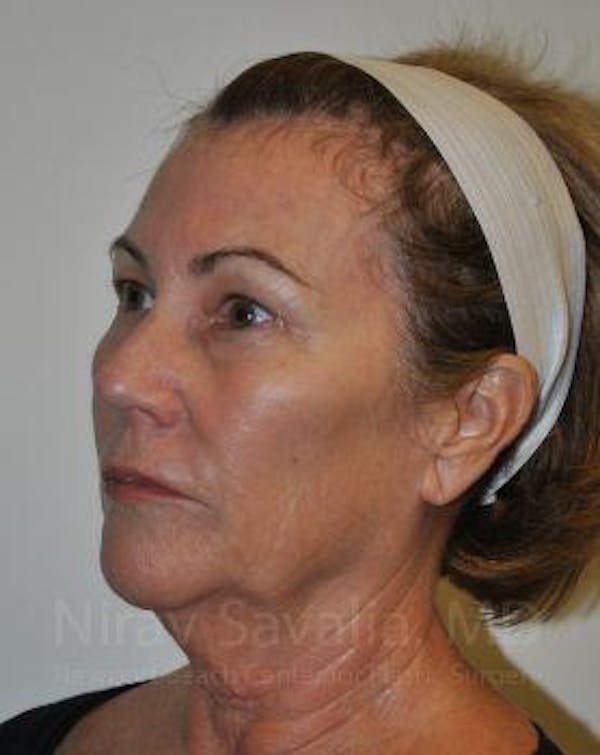 Fat Grafting to Face Before & After Gallery - Patient 1655695 - Before