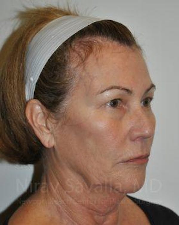 Fat Grafting to Face Before & After Gallery - Patient 1655695 - Before