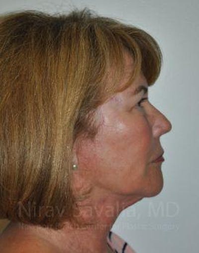 Fat Grafting to Face Before & After Gallery - Patient 1655695 - After