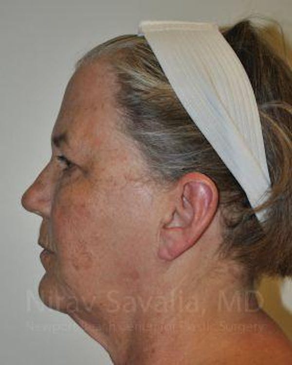 Eyelid Surgery Before & After Gallery - Patient 1655699 - Before