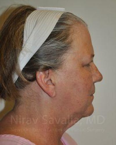 Eyelid Surgery Before & After Gallery - Patient 1655699 - Before