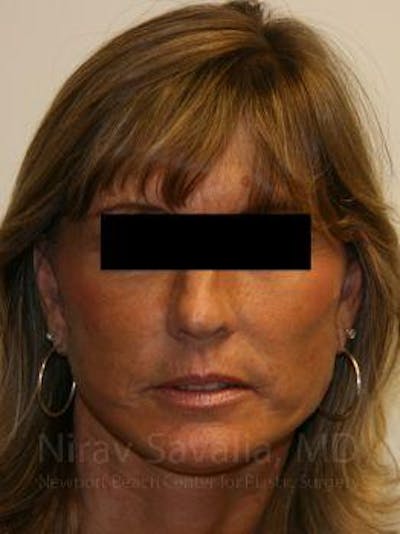 Breast Lift without Implants Before & After Gallery - Patient 1655704 - After