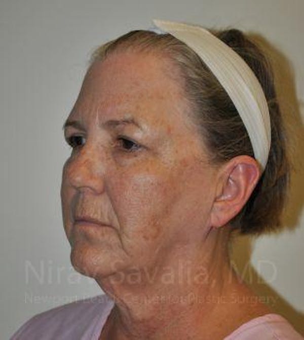 Mommy Makeover Before & After Gallery - Patient 1655705 - Before