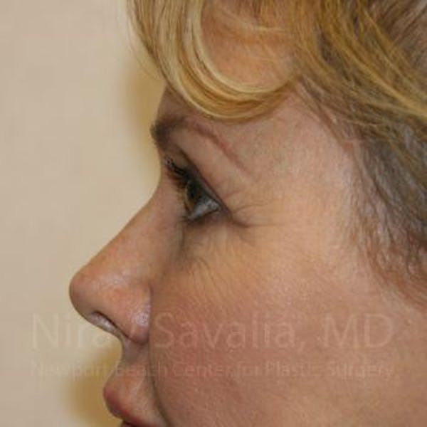 Mastectomy Reconstruction Before & After Gallery - Patient 1655706 - Before