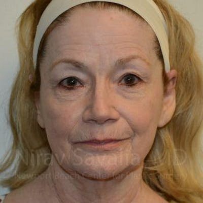 Fat Grafting to Face Before & After Gallery - Patient 1655710 - Before