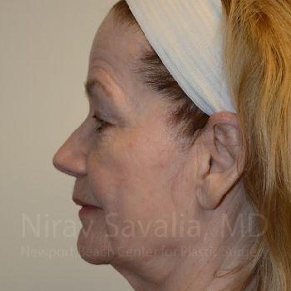 Fat Grafting to Face Before & After Gallery - Patient 1655710 - Before