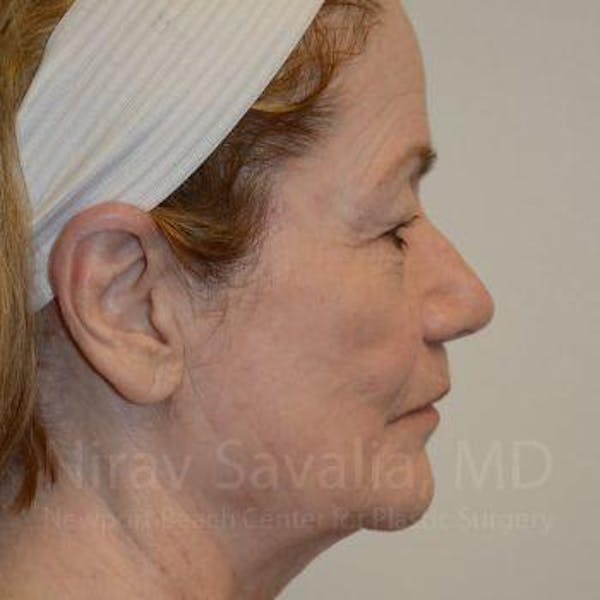 Fat Grafting to Face Before & After Gallery - Patient 1655710 - Before