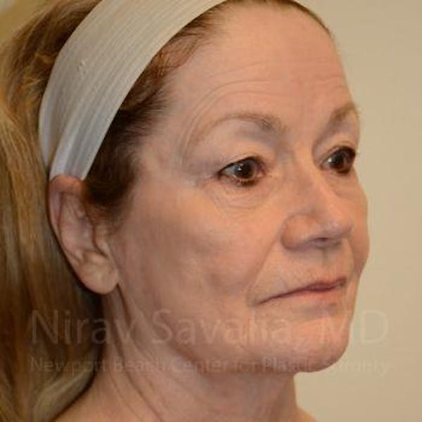 Fat Grafting to Face Before & After Gallery - Patient 1655710 - Before