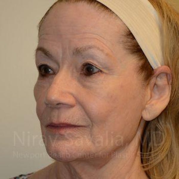 Fat Grafting to Face Before & After Gallery - Patient 1655710 - Before