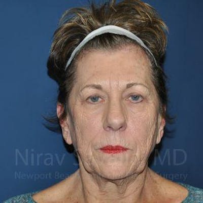 Fat Grafting to Face Before & After Gallery - Patient 1655716 - Before