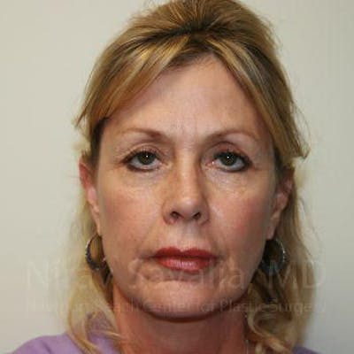 Fat Grafting to Face Before & After Gallery - Patient 1655714 - Before