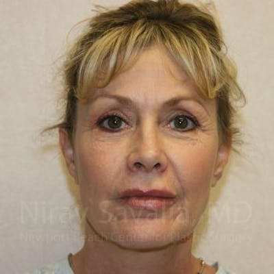 Fat Grafting to Face Before & After Gallery - Patient 1655714 - After