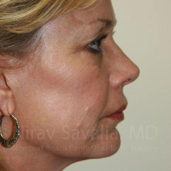 Fat Grafting to Face Before & After Gallery - Patient 1655714 - Before