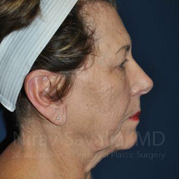 Fat Grafting to Face Before & After Gallery - Patient 1655716 - Before