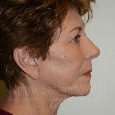 Fat Grafting to Face Before & After Gallery - Patient 1655716 - After