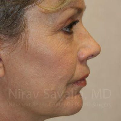 Fat Grafting to Face Before & After Gallery - Patient 1655714 - After