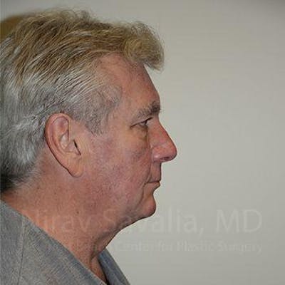 Fat Grafting to Face Before & After Gallery - Patient 1655717 - Before