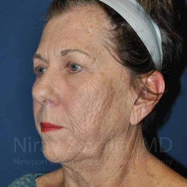 Fat Grafting to Face Before & After Gallery - Patient 1655716 - Before