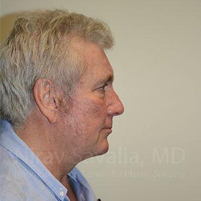 Fat Grafting to Face Before & After Gallery - Patient 1655717 - After